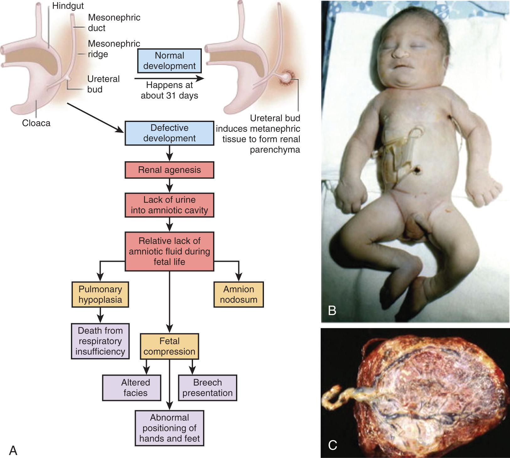 Fig. 128.6, A, Consequences of renal agenesis. B, Multiple deformational defects. C, Defects in amnion nodosum; brown-yellow granules from vernix have been ribbed into defects of the amniotic surface.