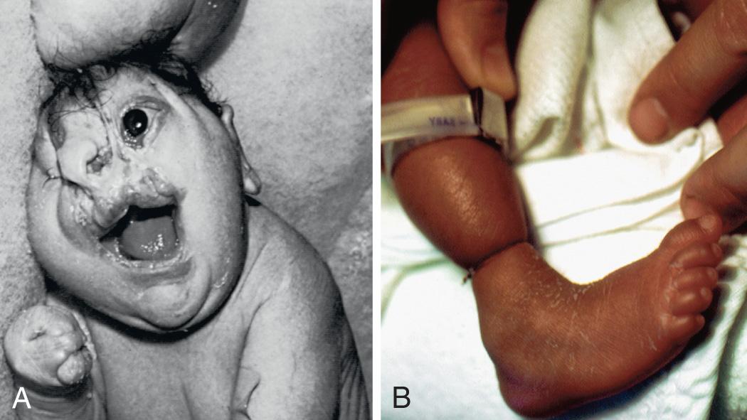 Fig. 128.8, A, Amniotic band disruption sequence. B, Bands constricting the ankle leading to deformational defects and amputations.