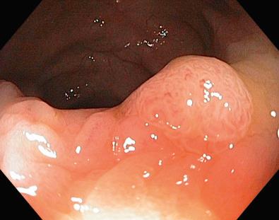 FIG 39.2, Polypoid dysplasia.