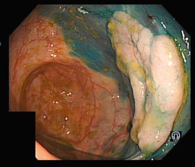 FIG 39.6, Cecal polypoid lesion in quiescent ulcerative colitis after indigo carmine dye spray.