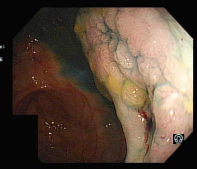 FIG 39.7, Cecal lesion in ulcerative colitis after dye spray.