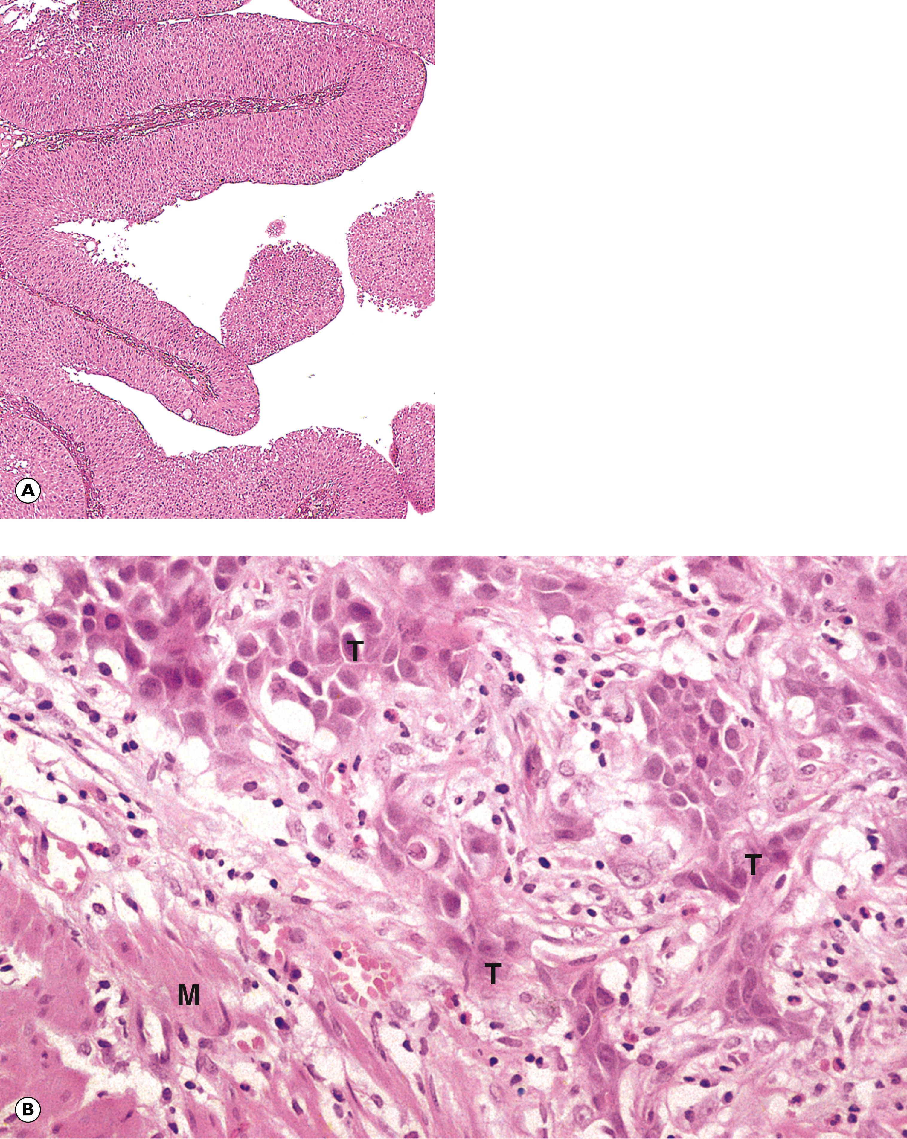 Fig. 7.4, Transitional cell (urothelial) carcinoma. (A) Low grade/grade 1 (LP); (B) high grade/grade 3 (HP).