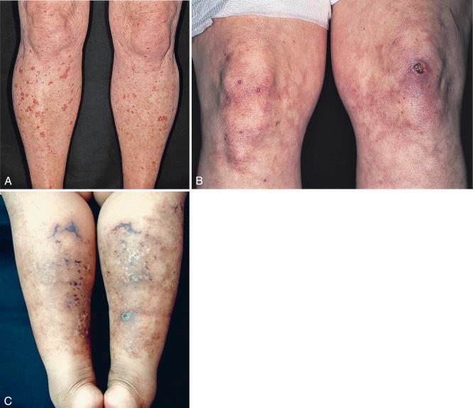 FIGURE 21-1, A and B, Palpable purpura in a patient with cryoglobulinemia. C, Retiform necrotic lesions in a patient with type I cryoglobulinemia.