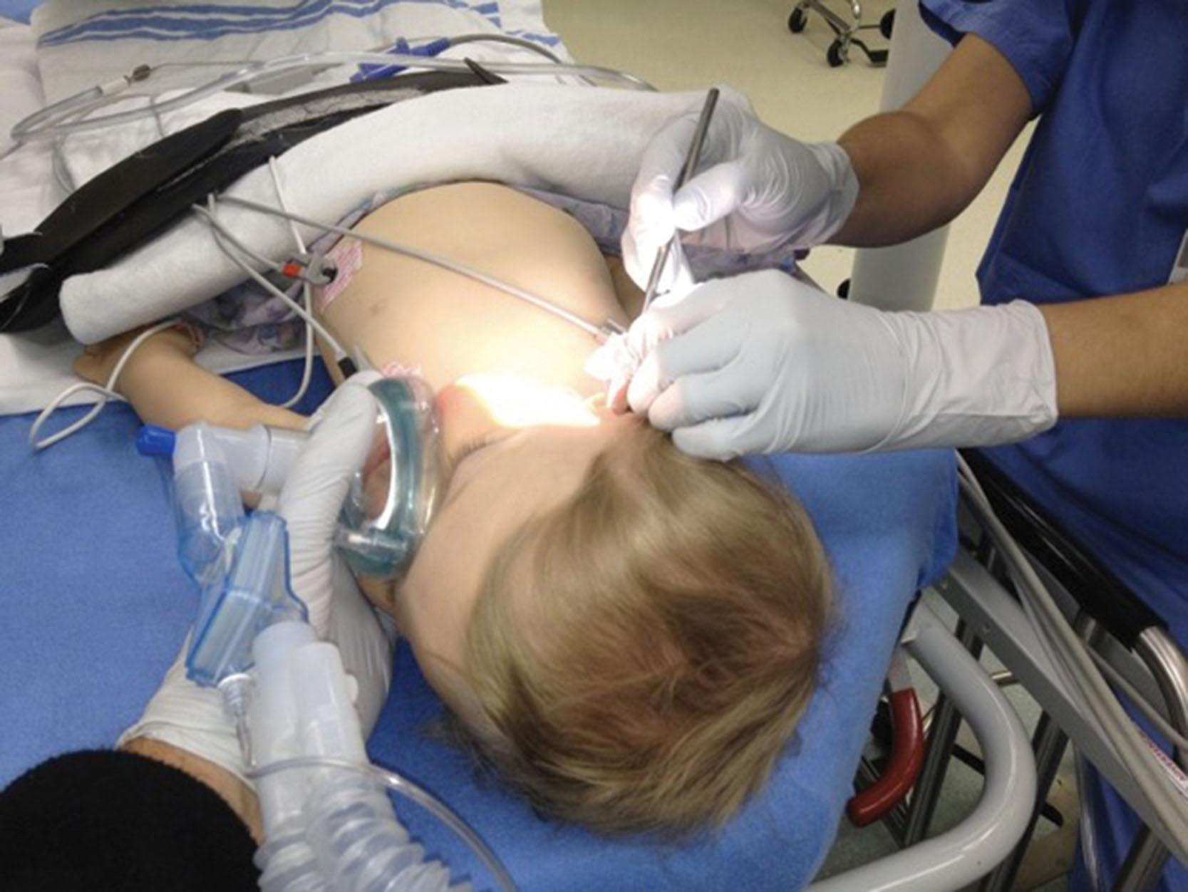 Fig 22.2, Myringotomy and tube insertion. During myringotomy and tube placement, face mask anesthesia is maintained with the child’s head rotated laterally. It takes practice keeping the surgical field still, and maintaining upper-airway patency. Courtesy of Ronald S. Litman.
