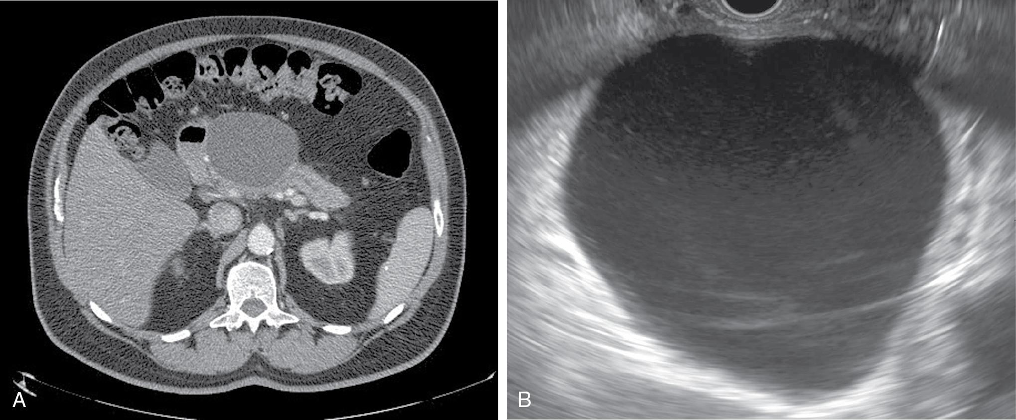 • Fig. 21.1, (A) Axial CT image of a pseudocyst. A definitive wall can be seen surrounding a fluid collection with no solid debris. (B) Pseudocyst on EUS—anechoic fluid collection with a definitive wall can be seen.