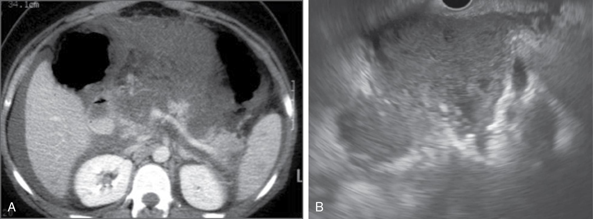 • Fig. 21.2, (A) Axial CT image of an acute necrotic collection. (B) Acute necrotic collection on EUS—this is characterized as an ill-defined fluid collection lacking a definitive wall.