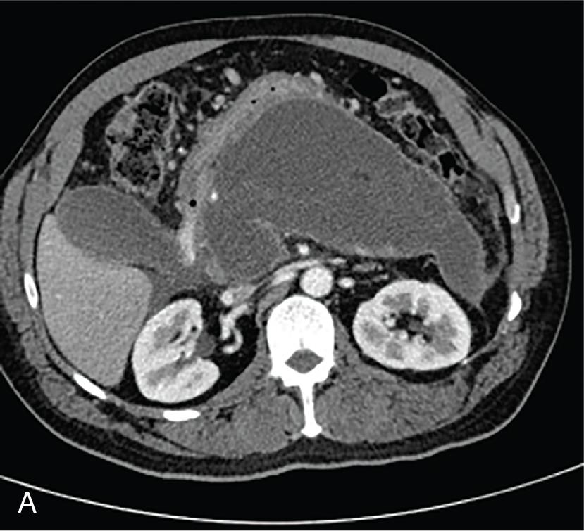 • Fig. 21.3, (A) Axial CT image of WON—a well-defined collection containing solid debris surrounded by an outer wall is seen. (B) WON on EUS—solid debris can be seen within the WON as hyperechoic structures.