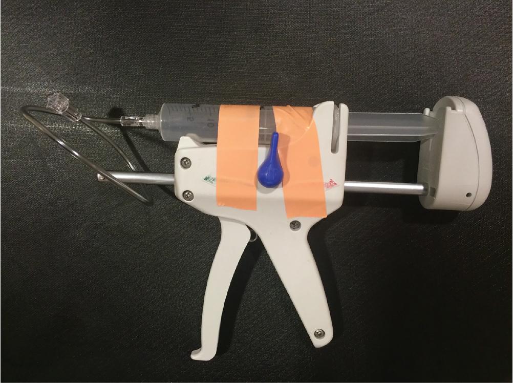 • Fig. 26.3, A typical high-pressure gun and chemotherapy syringe setup that is required to infuse the viscous ablation cocktail through the FNA needle and into the tumor in a timely fashion. A syringe using higher-grade plastic suitable for higher-pressure and short-braided connector tubing is recommended, as well as PVC-free materials. In addition, assure that all connections are snug and that no air is in the line prior to infusion.