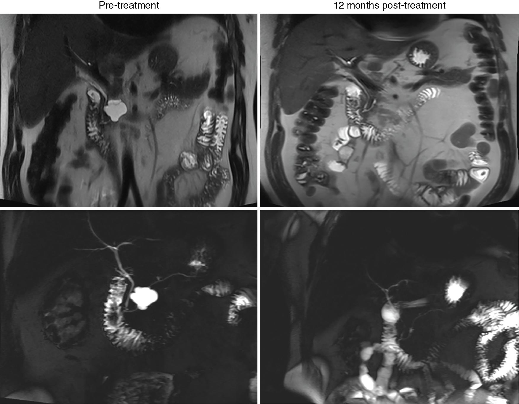 • Fig. 26.4, Before and after images of alcohol-free EUS-guided chemoablation of a 55-year-old male with a 3.3 × 3.0 cm mucinous-type cyst in the pancreatic neck with interval growth of over 2 mm/year. Both enhanced MRI and MRCP pretreatment and 12 months posttreatment images are shown with no residual cyst noted (complete response).