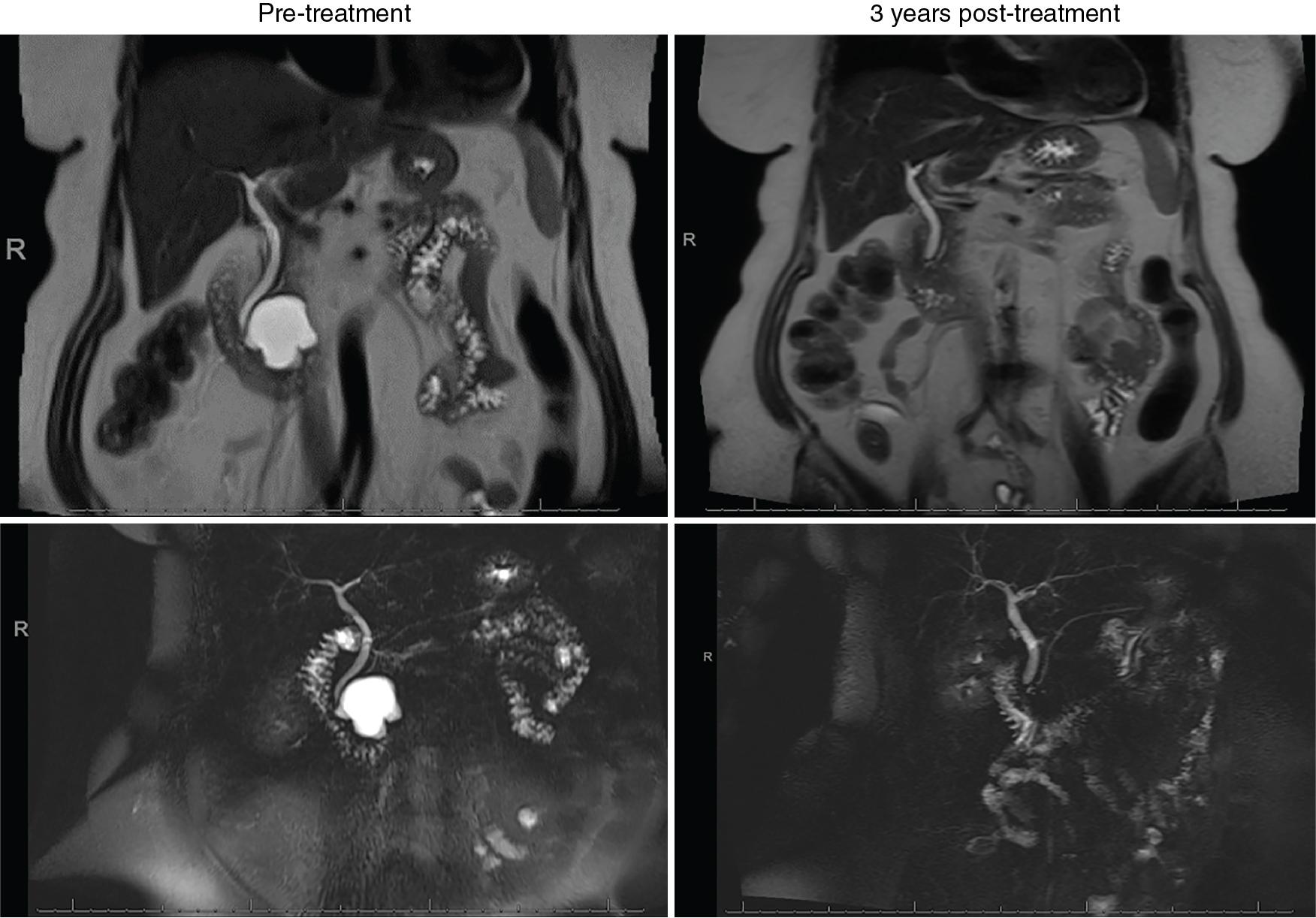 • Fig. 26.5, Alcohol-free EUS-guided chemoablation of an 82-year-old, otherwise healthy female with a 3.5-cm mucinous-type pancreatic cyst in the head and uncinate of the pancreas treated with one session of EUS-guided chemoablation. Enhanced MRI and MRCP both pretreatment and 3 years posttreatment are shown with no residual cyst noted (complete response).