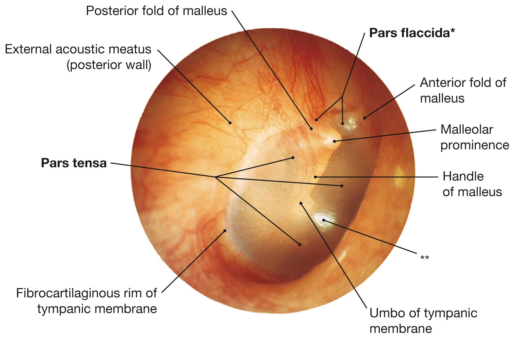 Fig. 10.12, Tympanic membrane, right side; lateral view; otoscopic image.