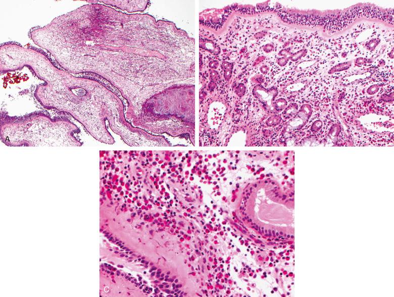 Figure 7.1, Chronic rhinosinusitis.