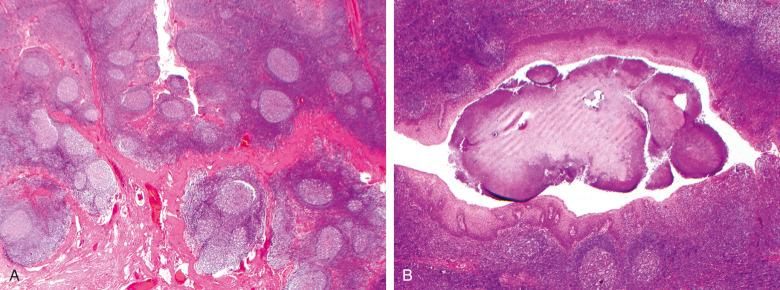 Figure 7.3, Chronic tonsillitis.