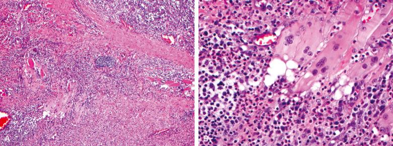 Figure 7.4, Peritonsillar abscess.