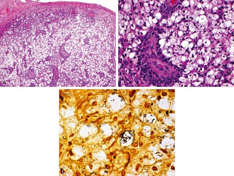 Figure 7.5, Rhinoscleroma.