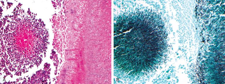 Figure 7.6, Actinomycosis.