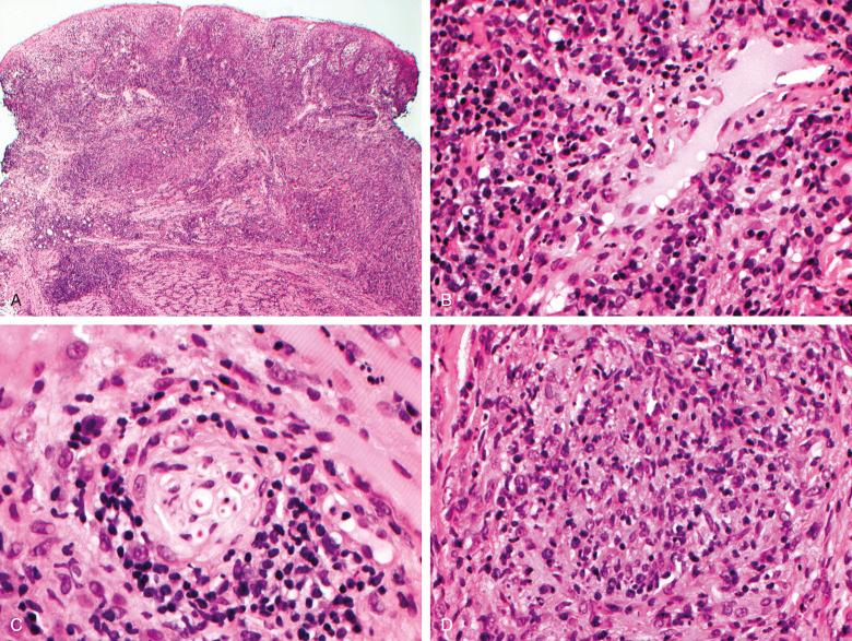 Figure 7.7, Primary syphilis.