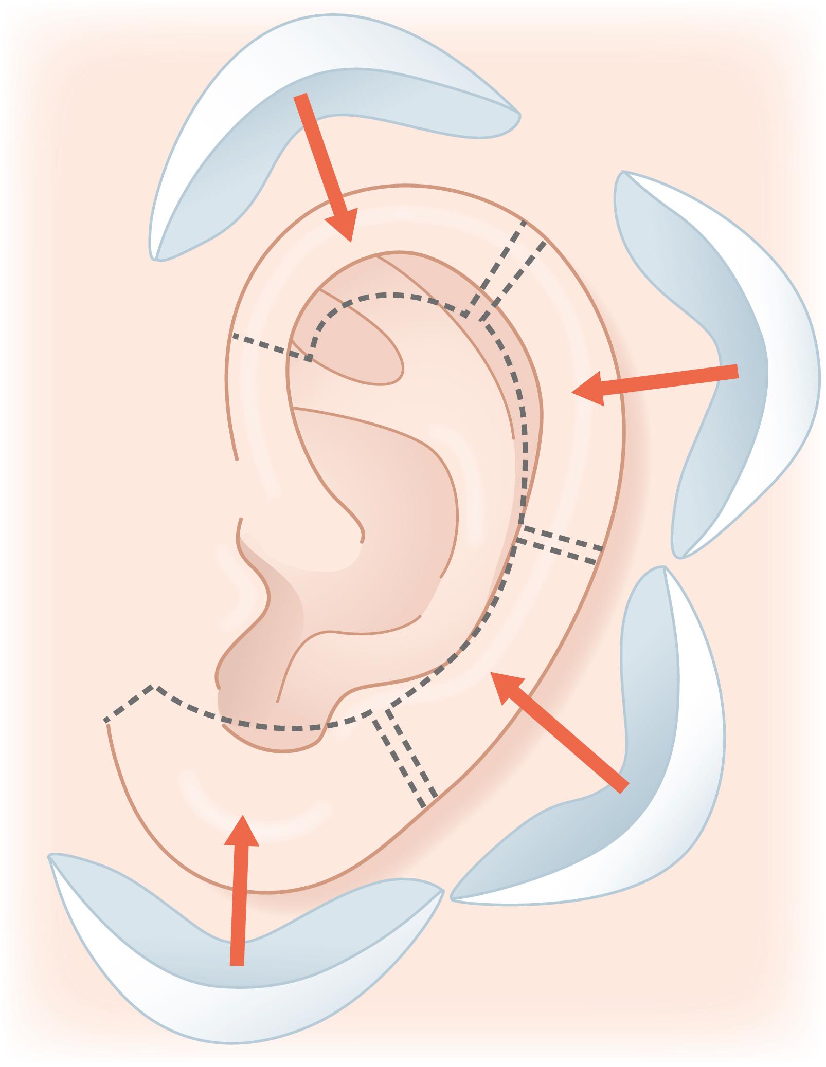 Fig. 32.1, Fibrocartilaginous conchal graft can only be used when the defect is no more than a quarter of the ear and no more than two adjacent planes.