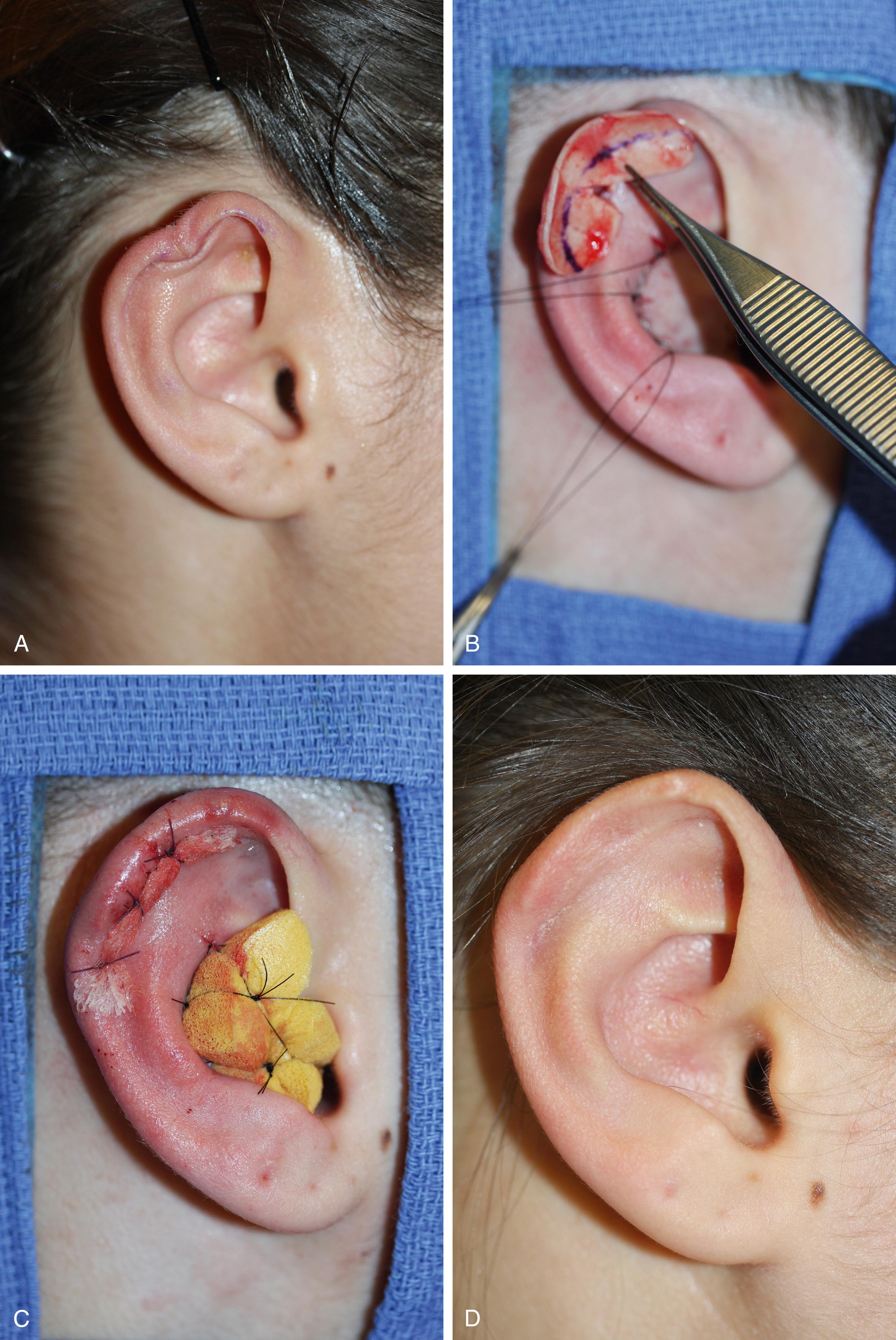 Fig. 32.2, Case 1. (A) The defect is a quarter of the ear and no more than two planes. (B) The conchal graft harvested on the same ear by an anterior approach will be reduced to reproduce the missing contours. (C) Bolster sutures apply the skin to the underlying contours. (D) Result.