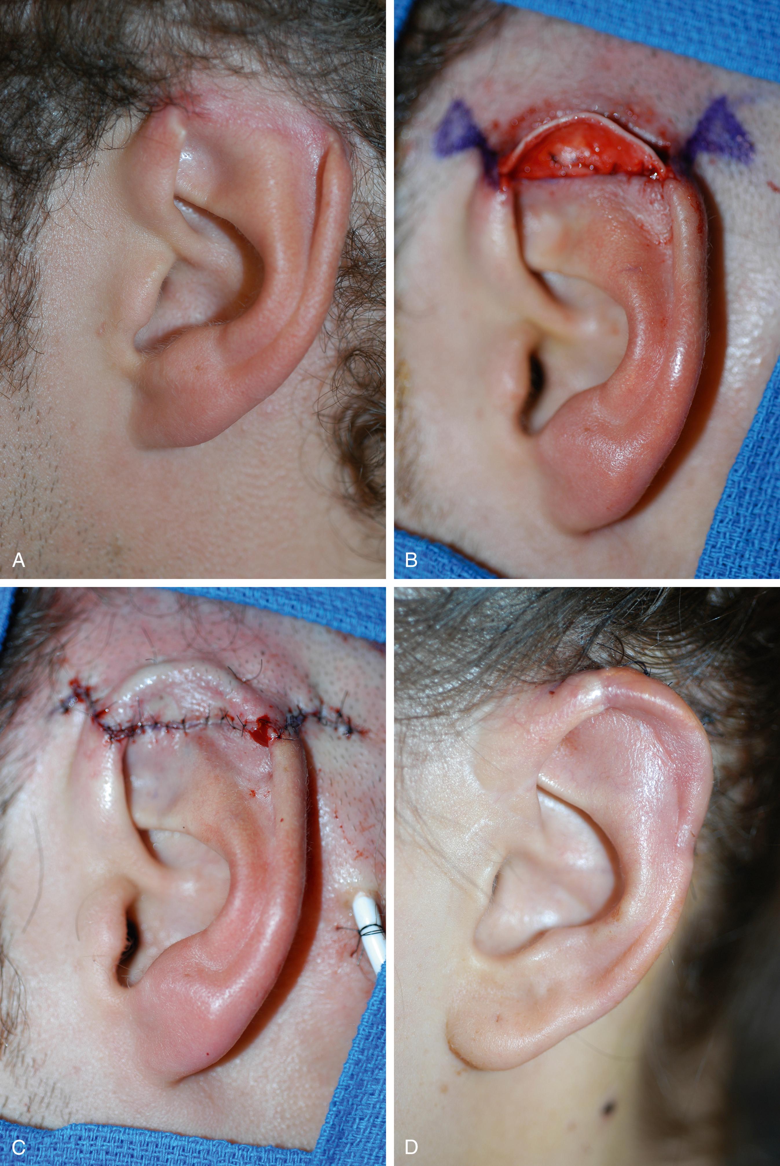 Fig. 32.3, Case 2. (A) The defect is a quarter and no more than two adjacent planes. (B) The conchal graft harvested on the contralateral ear is sutured to the fibrocartilage and the retroauricular skin will cover it. (C) Appearance after the first stage. (D) Result after elevation of the reconstructed contours using a full-thickness skin graft harvested from the contralateral retroauricular sulcus.