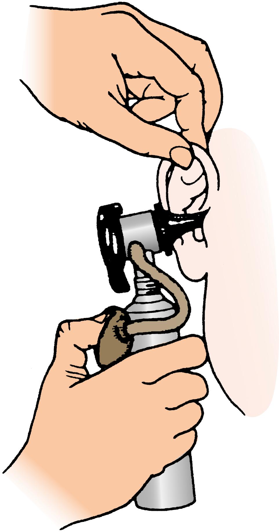 Fig. 5.2, Technique for pneumatic otoscopy.