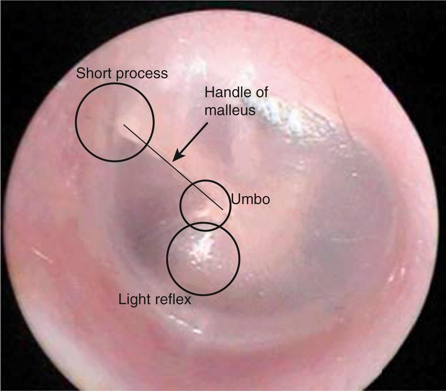 Fig. 5.3, Normal tympanic membrane with normal landmarks identified.