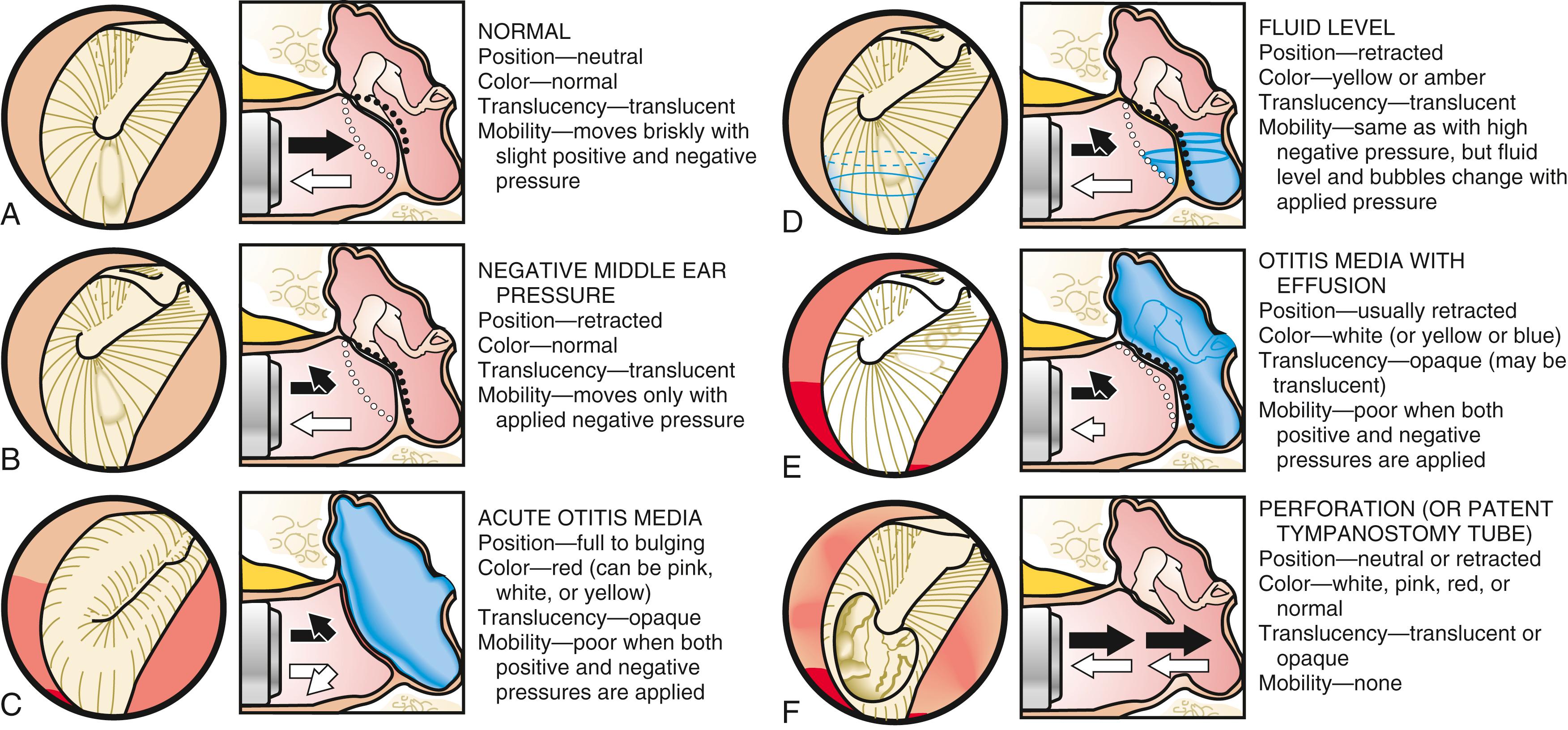 Fig. 5.4, A–F, Common conditions of the middle ear, as assessed with the otoscope.