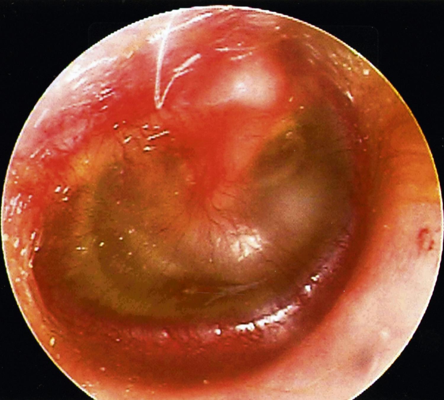 Fig. 5.5, Tympanic membrane in otitis media with effusion.