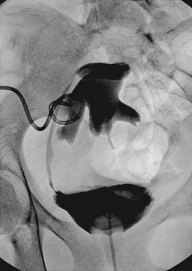 Fig. 14.2, This intraabdominal kidney transplant was found by ultrasound to be obstructed. A nephrostomy tube was placed, and a nephrostogram was obtained the next day. The kidney had rotated medially and twisted the ureter proximally. The patient was managed operatively by placing the kidney laterally in a retroperitoneal pocket and performing ureteroureterostomy using the ipsilateral native ureter.