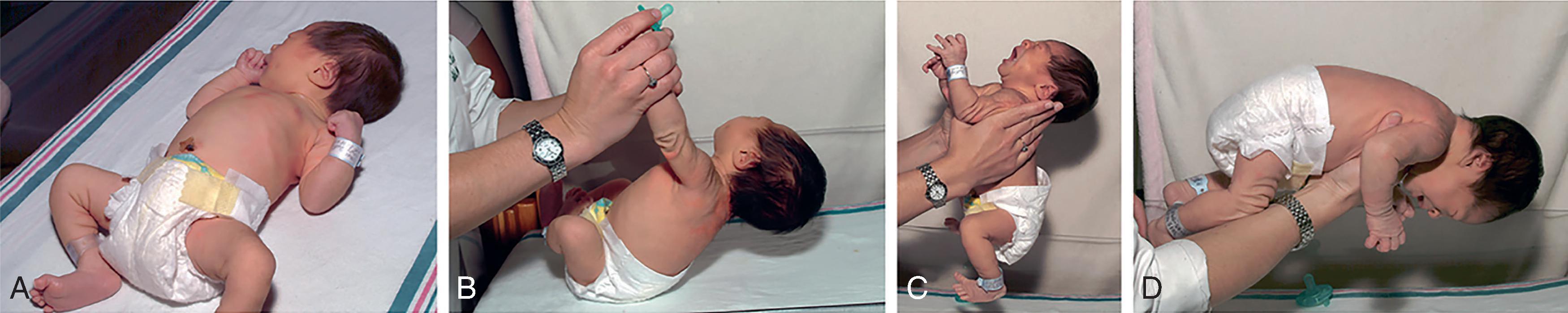 Fig. 93.2, Normal Tone in a Full-Term Neonate .