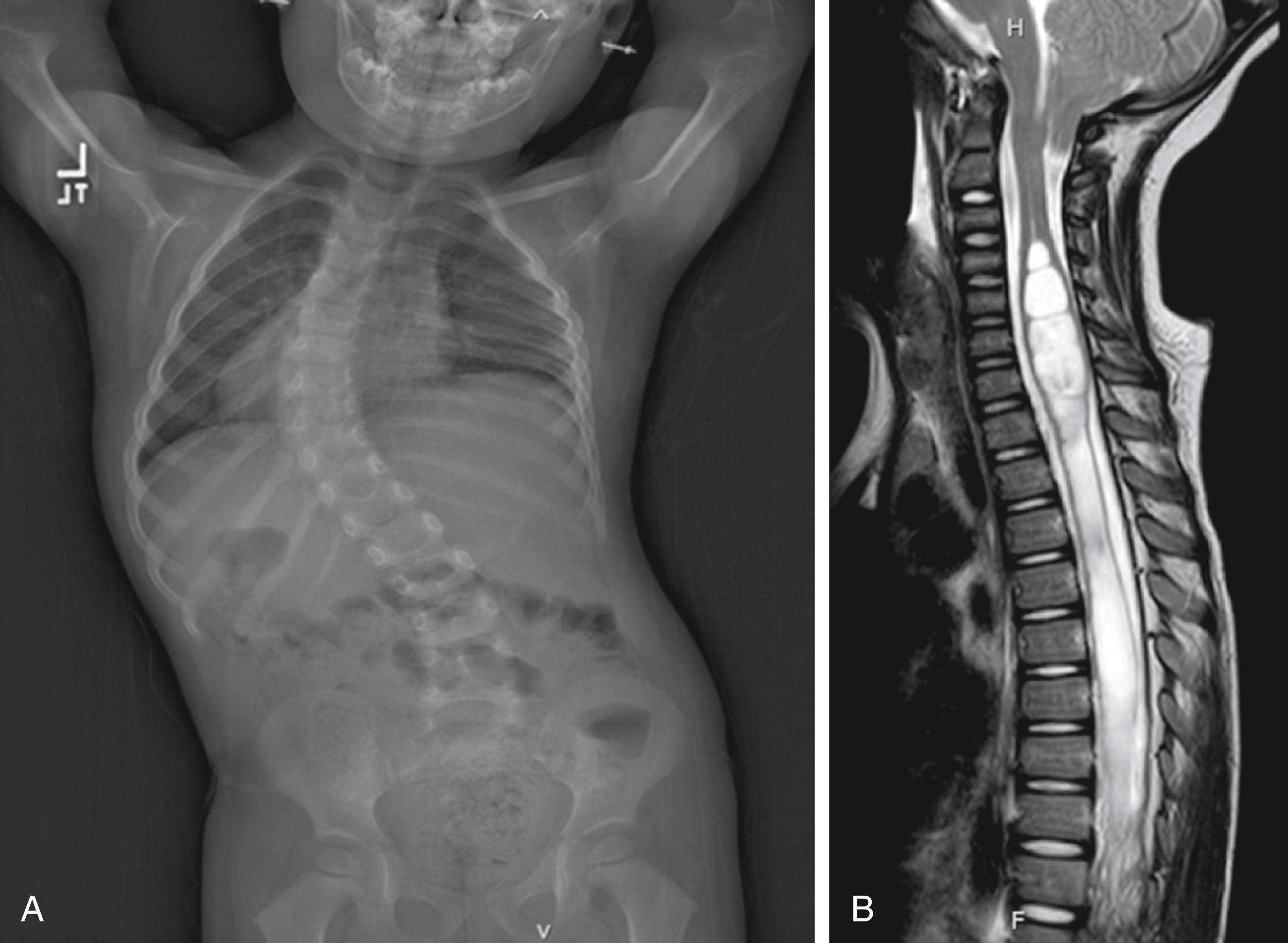 Fig. 20.2, Radiograph ( A ) and screening magnetic resonance imaging ( B ) of a child with early-onset scoliosis. Magnetic resonance imaging demonstrates holochord syrinx and type 1 Chiari malformation.