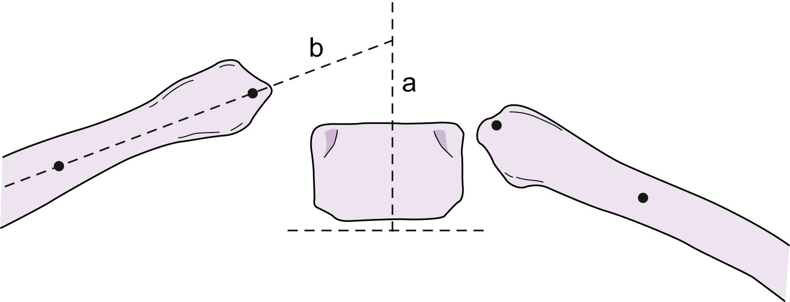 Fig. 20.3, Measuring the rib-vertebra angle difference (RVAD). A line is drawn perpendicular to the inferior end plate of the apical thoracic vertebra. Another line is drawn between two points that bisect the head and neck of the rib articulating with the apex. The angle between the perpendicular line ( a ) and the rib line ( b ) is measured. The same procedure is repeated for the rib on the opposite side. The concave–convex side angles are equal to the RVAD.