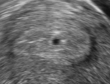 • Fig. 5.1, A normal intrauterine pregnancy at 4 weeks’ gestation.