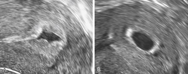 • Fig. 5.2, A, A pseudosac. B, A normal uterine pregnancy.