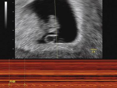 • Fig. 5.4, Embryonic heart rate measurement using M-mode.