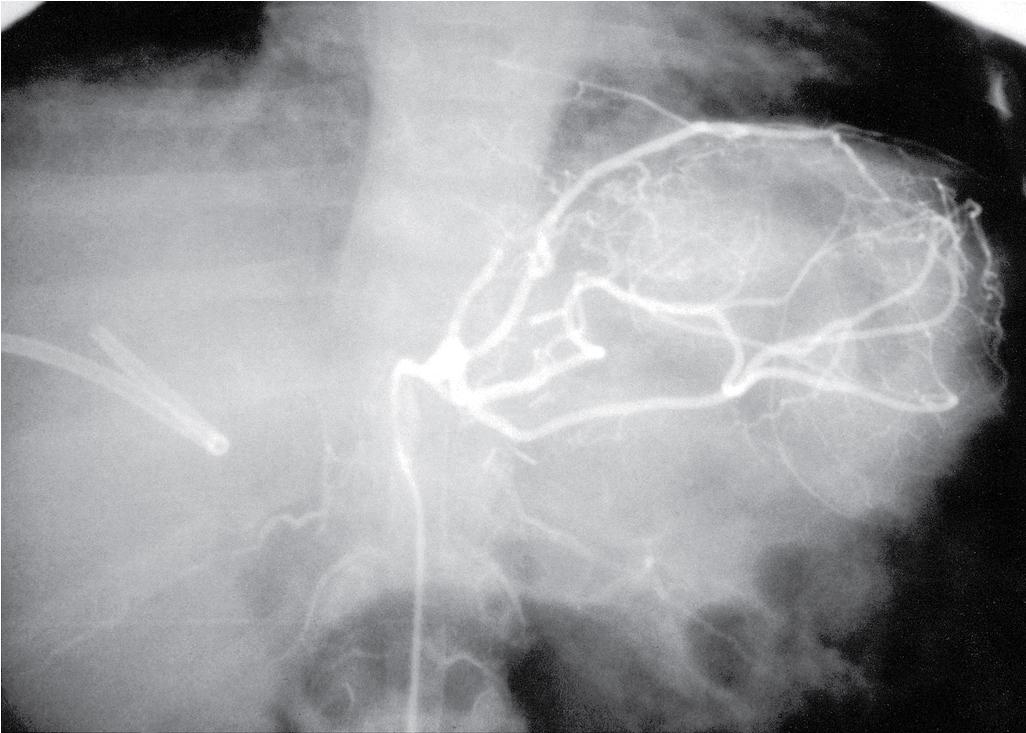 FIGURE 111.1, Hepatic artery thrombosis.