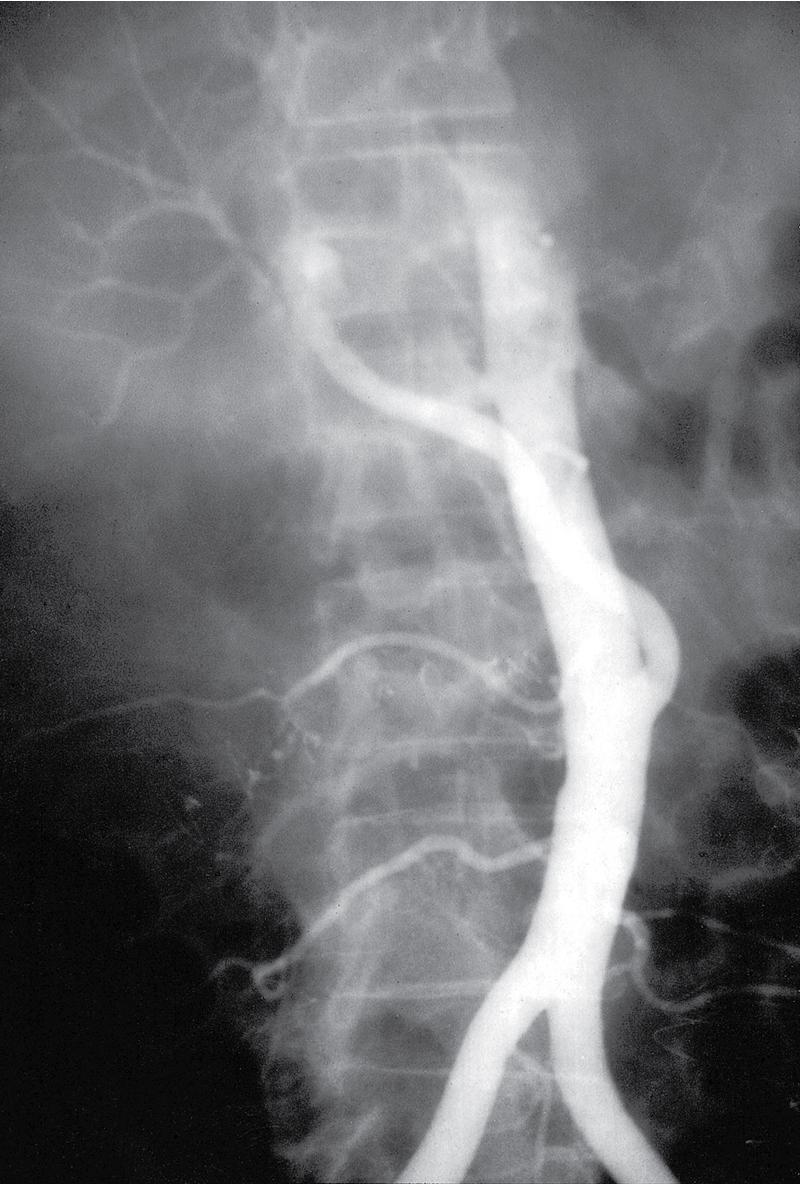 FIGURE 111.2, Hepatic artery reconstruction.