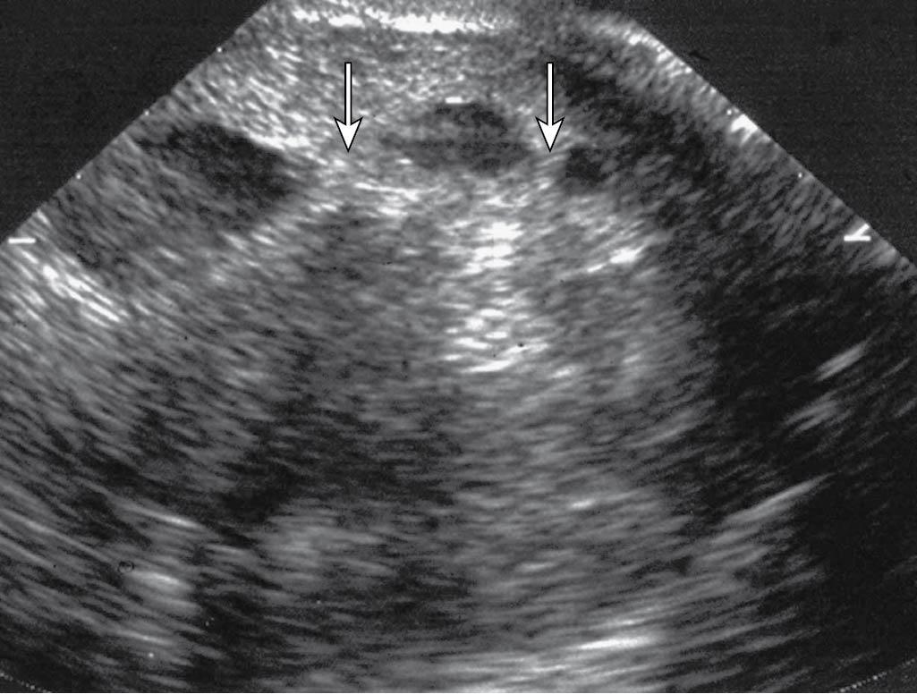 Fig. 16.4, Sonohysterography of intrauterine adhesions (arrows).