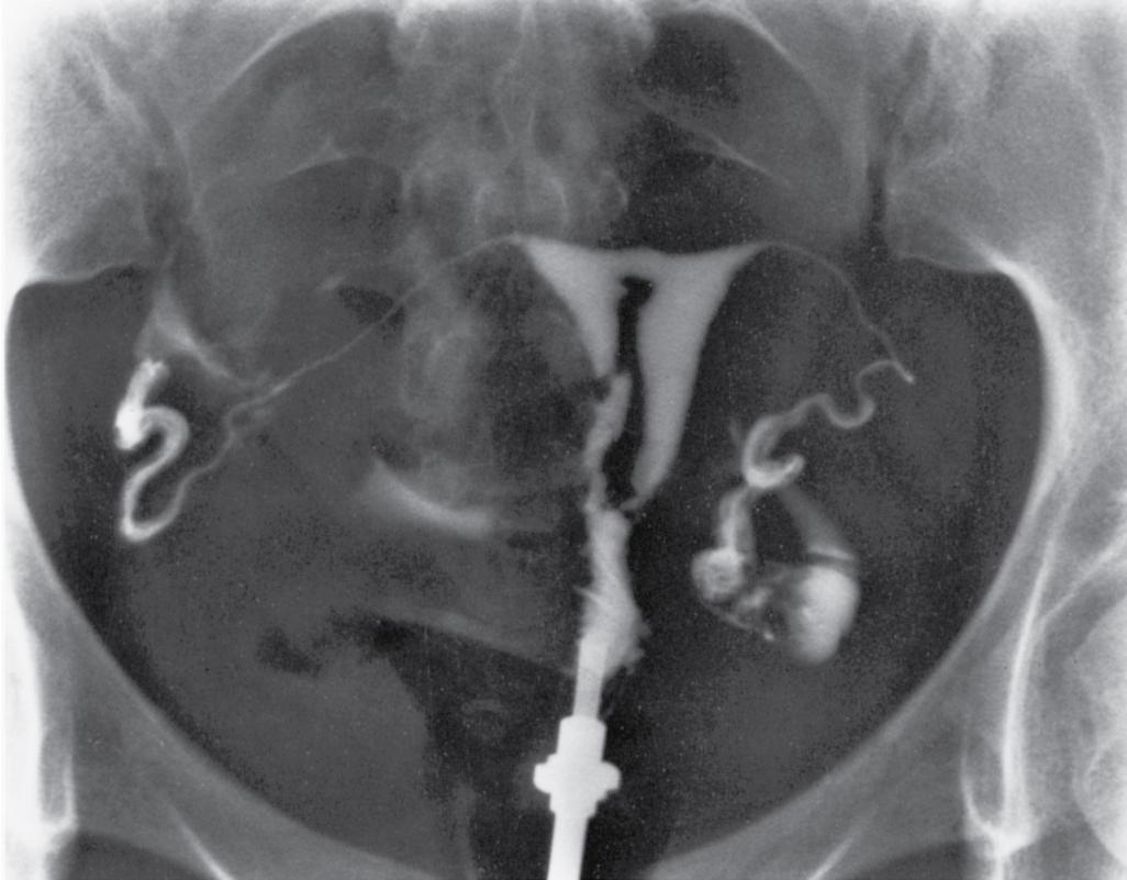 Fig. 16.5, Endometrial adhesions. The patient was a 23-year-old gravida 5, para 0, spontaneous abortus 4, ectopic 1, with previous left linear salpingostomy, being evaluated for recurrent pregnancy loss. Irregular, linear filling defect represents adhesions between anterior and posterior walls of the endometrial cavity, extending from the internal os to a level near the fundus.