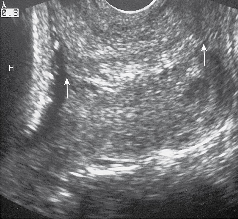 Fig. 16.6, Transvaginal ultrasound of a normal-appearing cervix. Large arrow to small area denotes canal from external os to internal os, respectively. H, Fetal head.