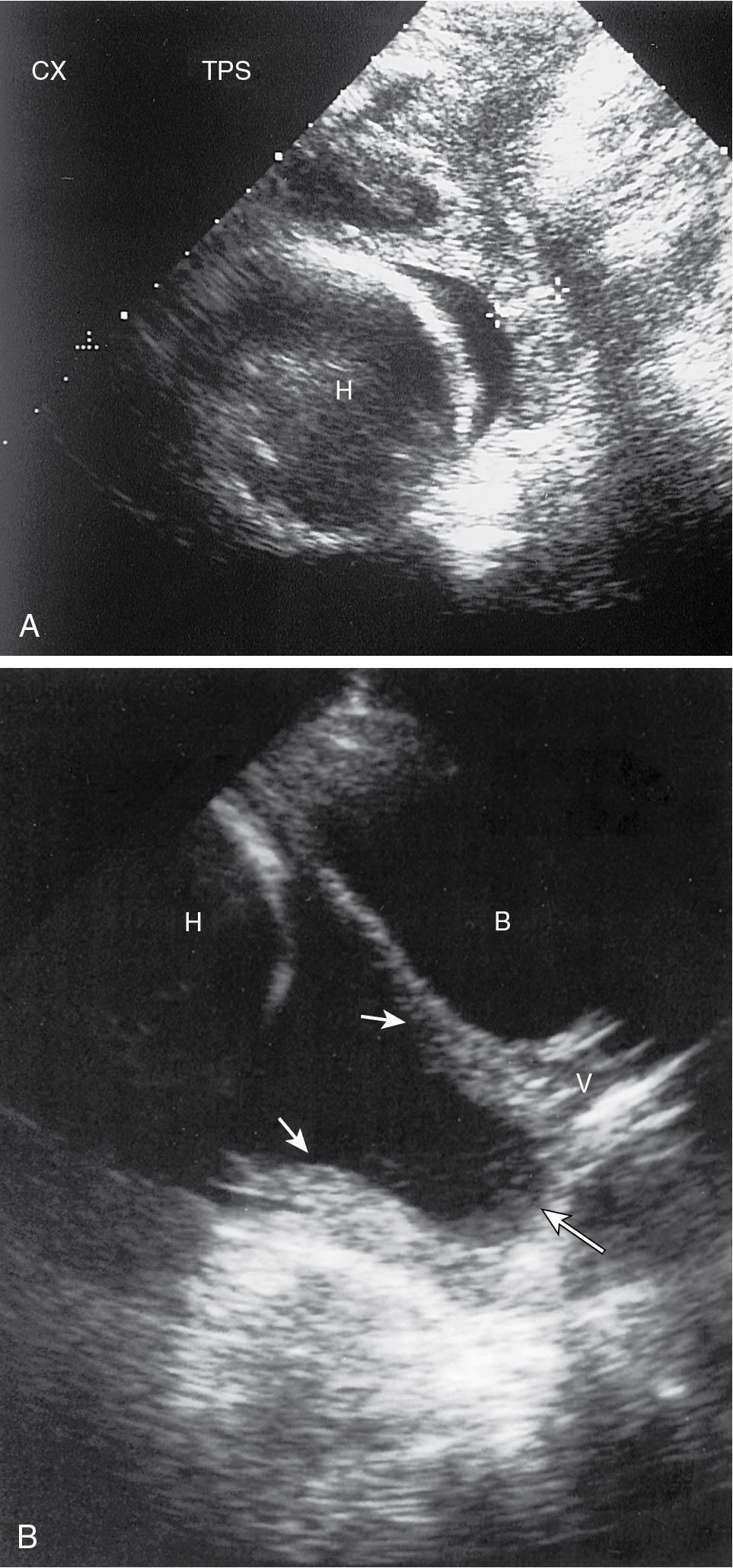 Fig. 16.7, A, Cervical shortening, the cervix was measured as 15 mm. Cursors are on the cervix. B, Advanced funneling or herniation of the membranes into the canal. This view was seen on transabdominal scan ( small arrows, internal os; large arrow, external os). B, Maternal bladder; CX, cervix; H, fetal head; TPS, transperineal scan; V, vagina.