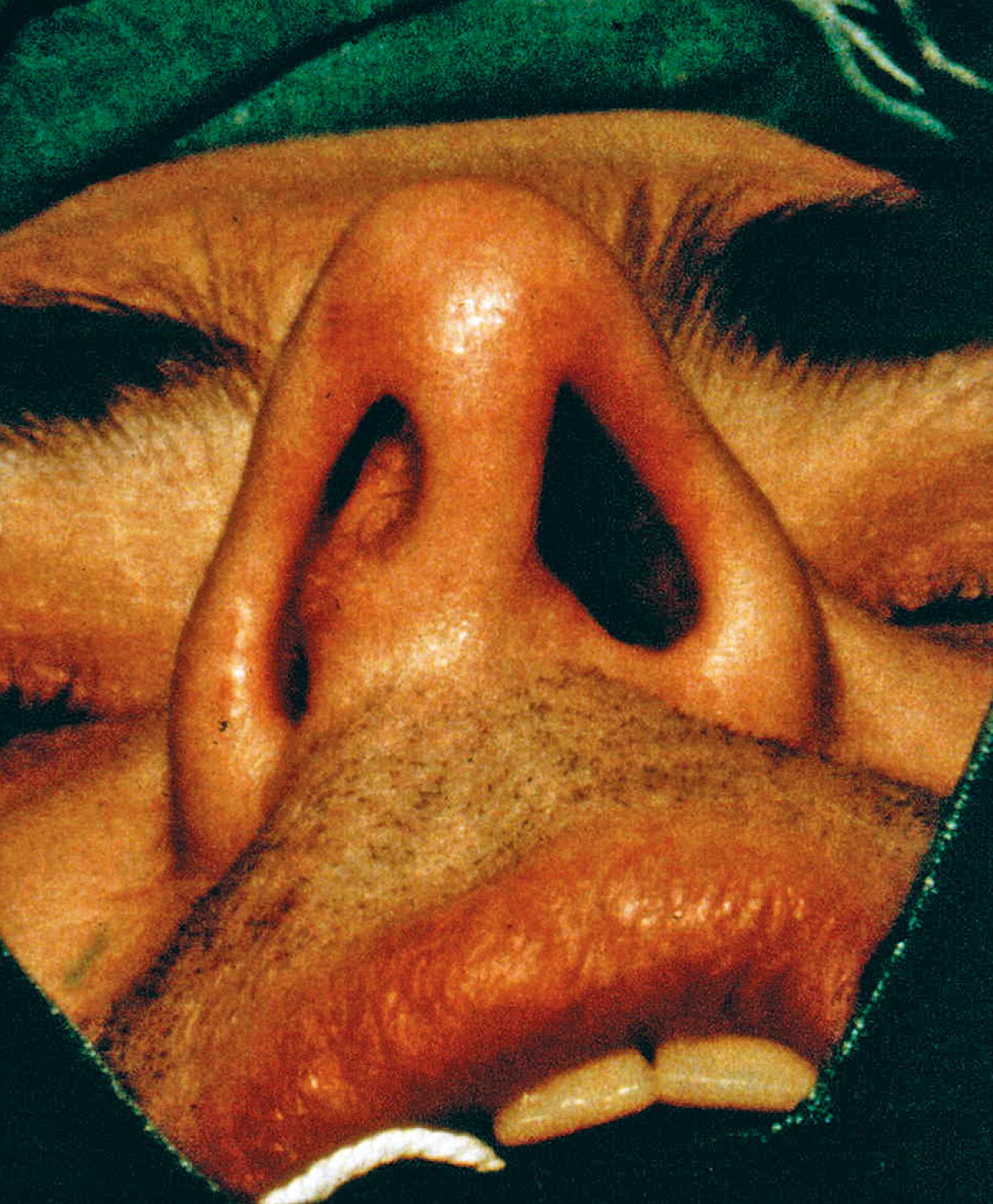 Fig. 27.11, Deviated nasal septum.