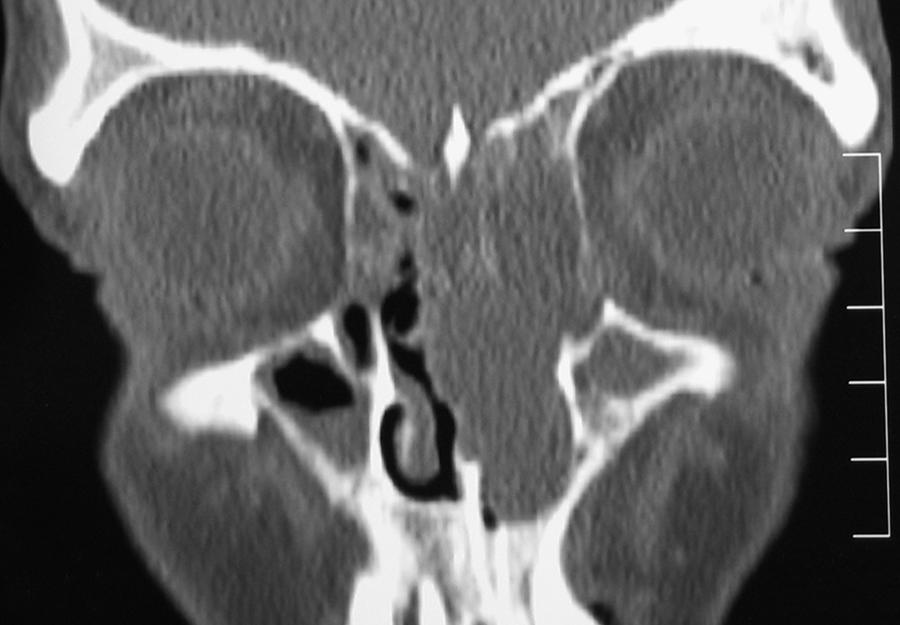 Fig. 27.12, Coronal computed tomography showing gross unilateral (Left) nasal ‘polyp’.