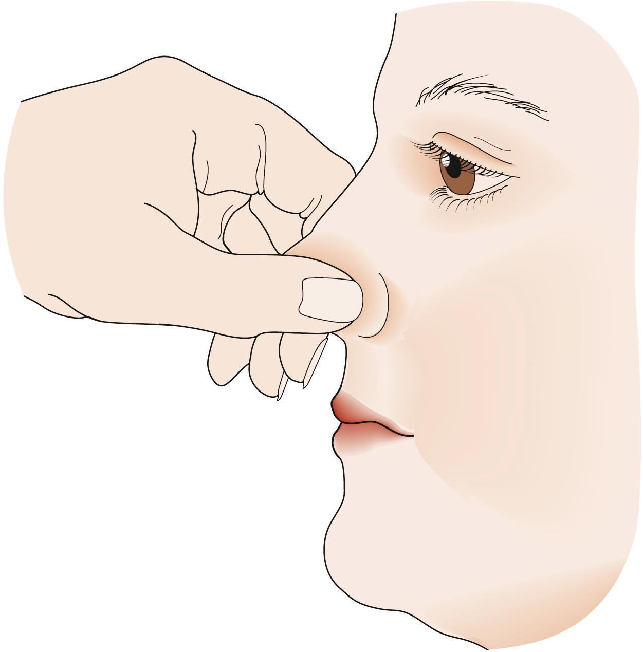 Fig. 27.13, Stopping epistaxis by squeezing the nose.