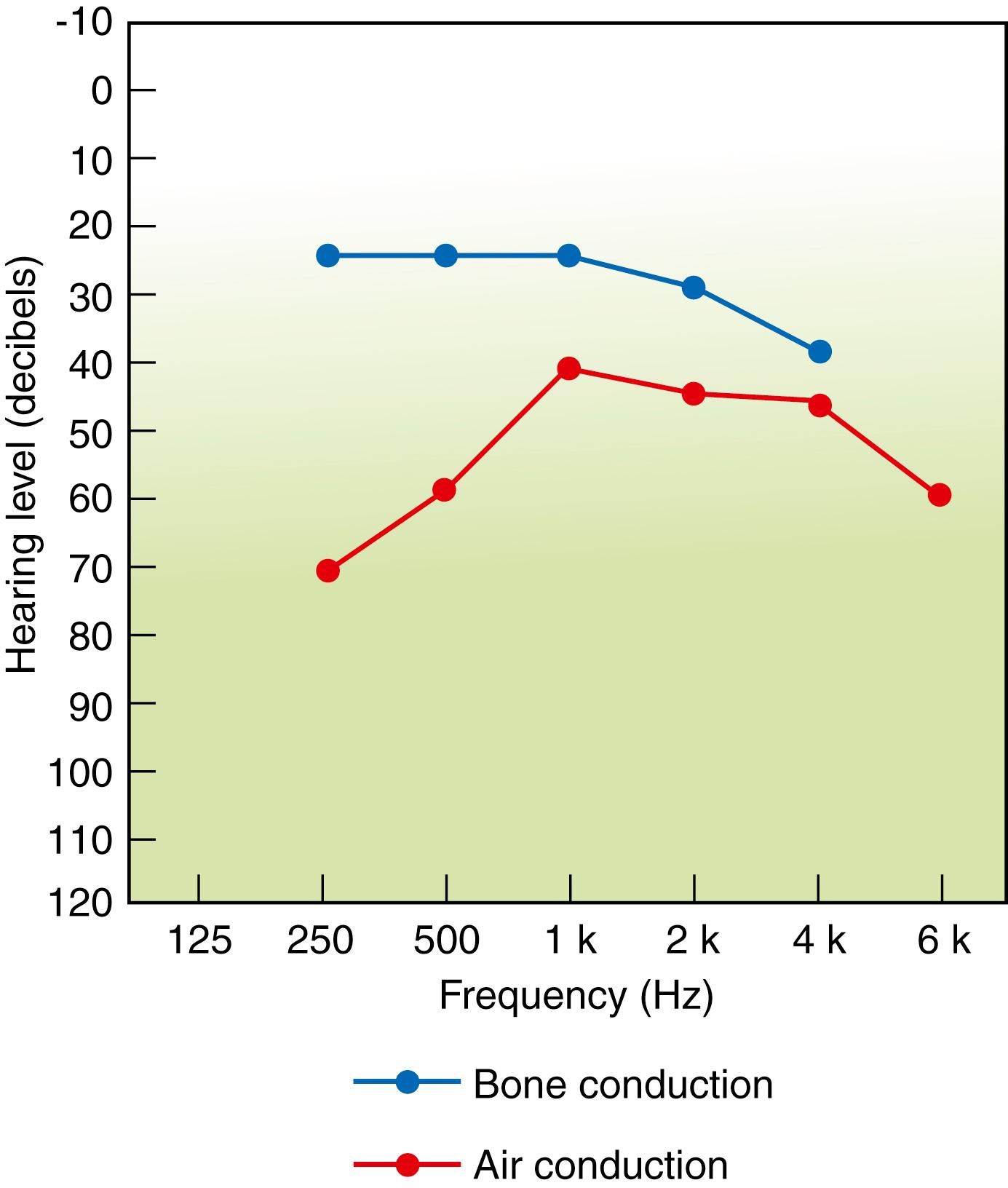 Fig. 27.3, Audiogram showing conductive deafness.