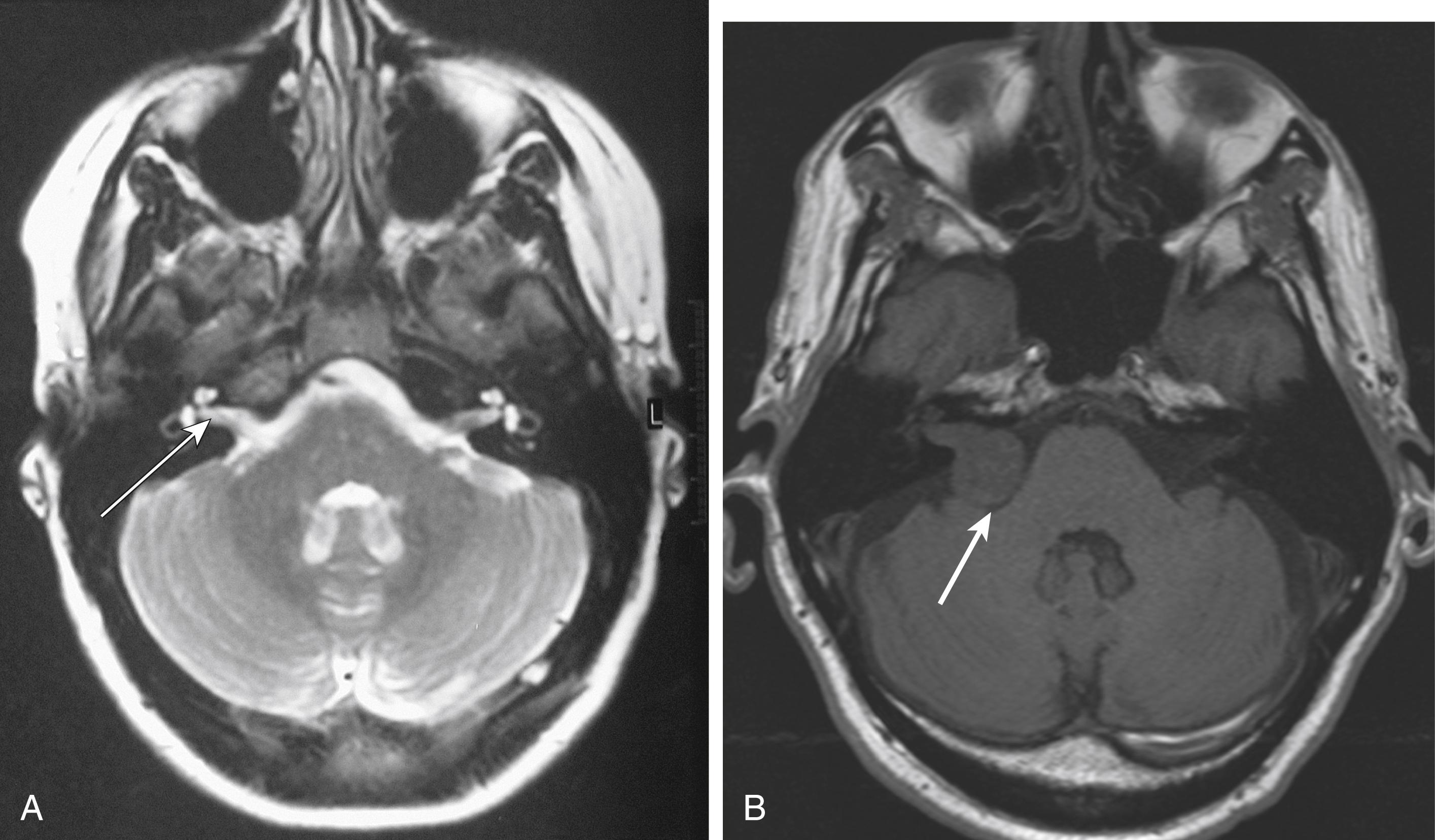 Fig. 27.5, Magnetic resonance imaging of the cerebellopontine angle. (A) Normal magnetic resonance image (MRI) scan of cerebellopontine angle. (B) MRI showing a acoustic neuroma. Thin arrow, internal auditory meatus (IAM); thick arrow, lesion compressing cerebellum.