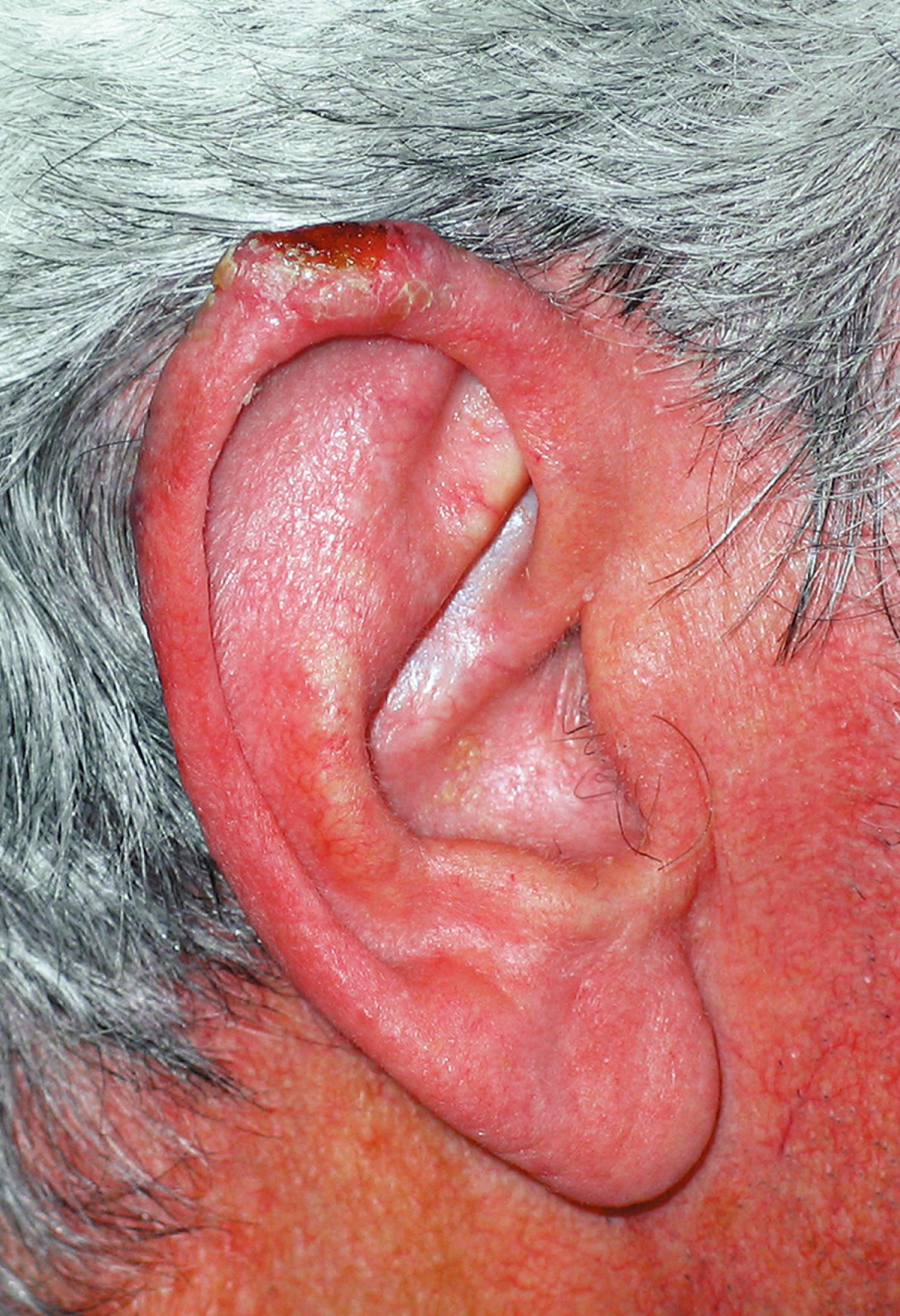 Fig. 27.6, Squamous carcinoma of the pinna.