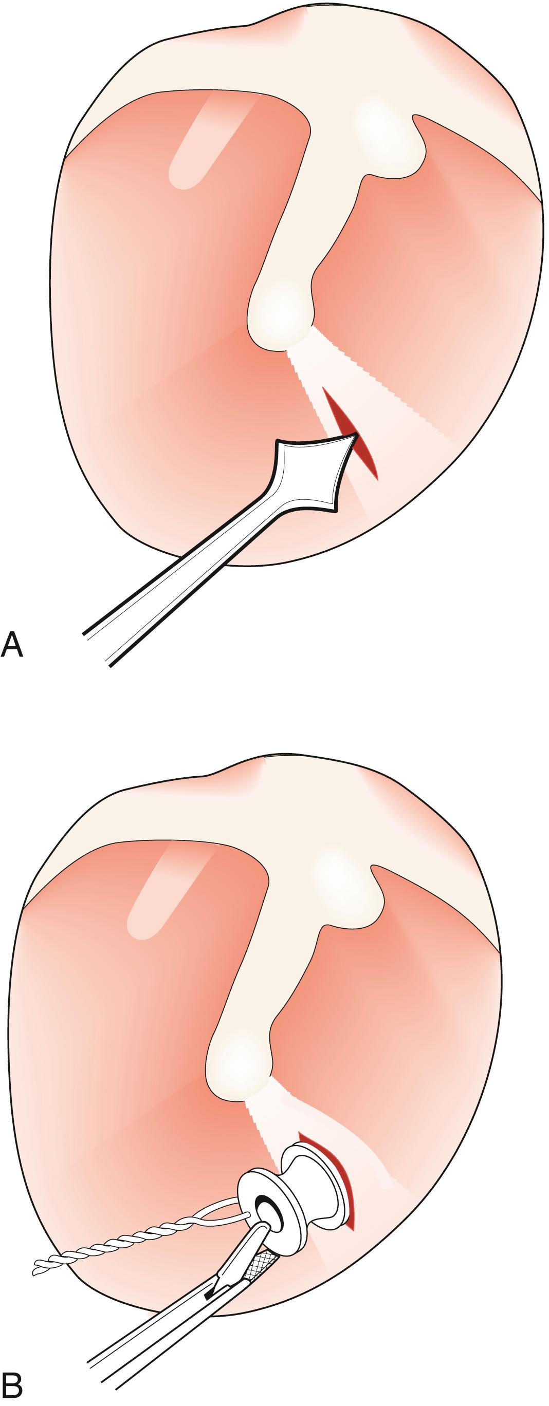 Fig. 27.7, Surgical treatment of otitis media with effusion. (A) Myringotomy. (B) Grommet insertion.