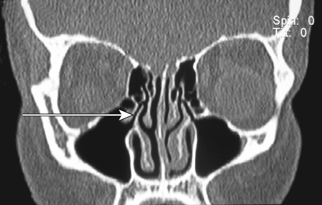 Fig. 27.10, Coronal computed tomography of sinuses. The narrow maxillary ostia and uncinate processes are seen on this cut ( arrow ), lateral to the middle turbinate.