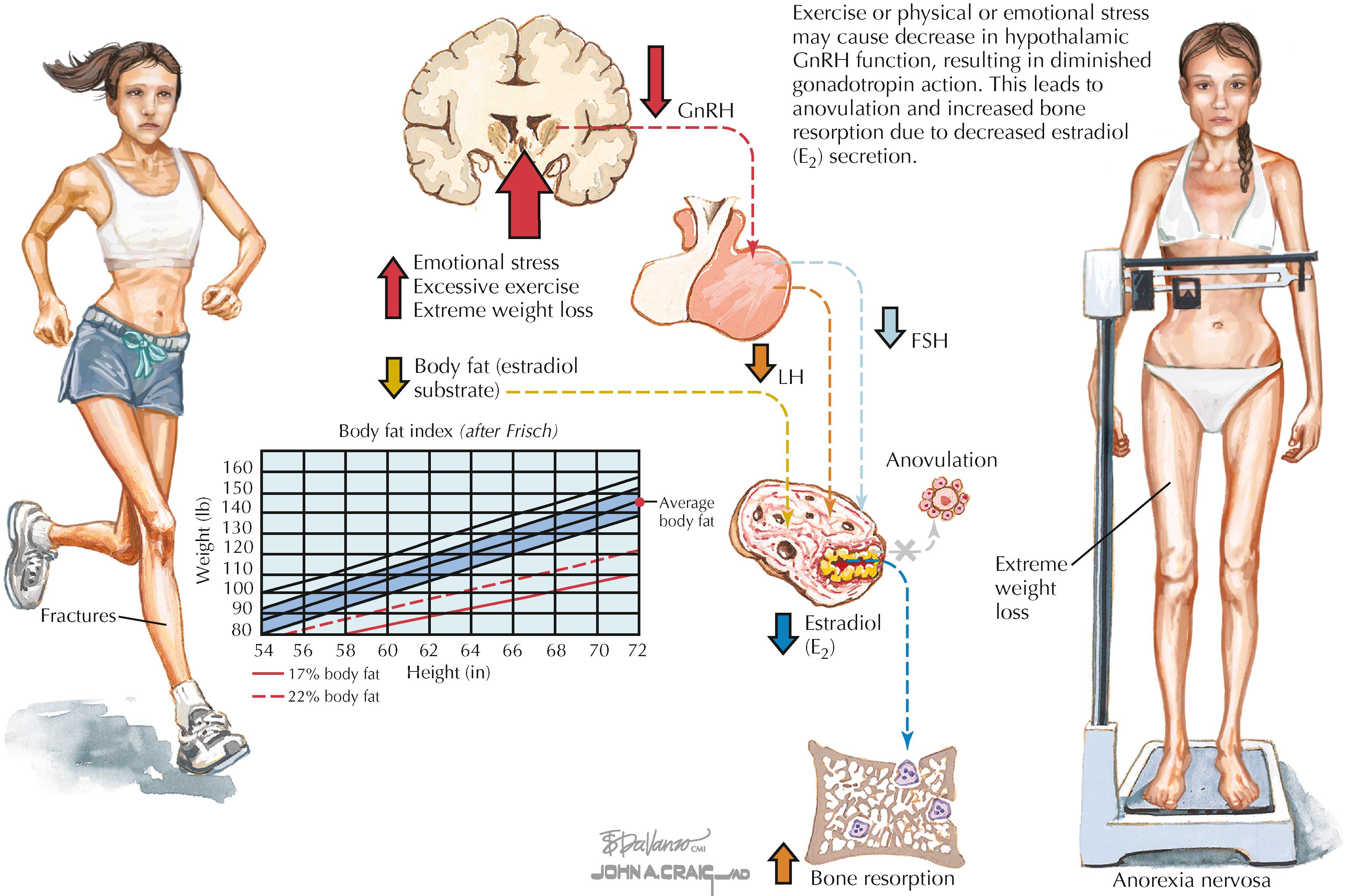 Figure 27.2, Osteoporosis associated with amenorrhea.